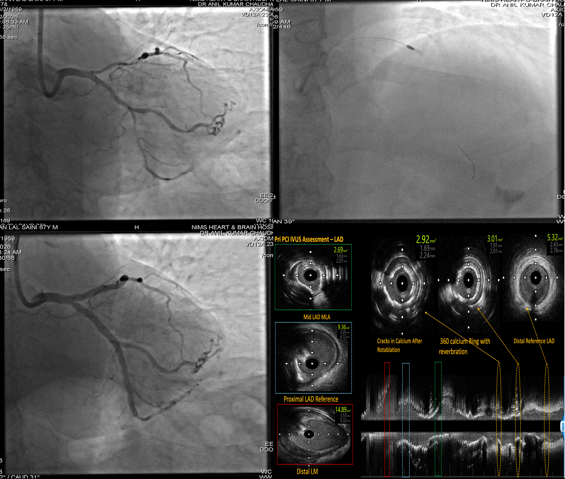 Coronary Angiography